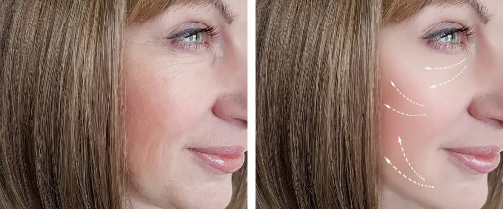 Radio Frequency Facial Ruined My Skin.